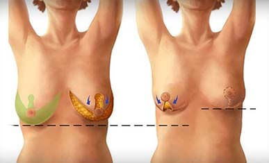 Breast Reduction –