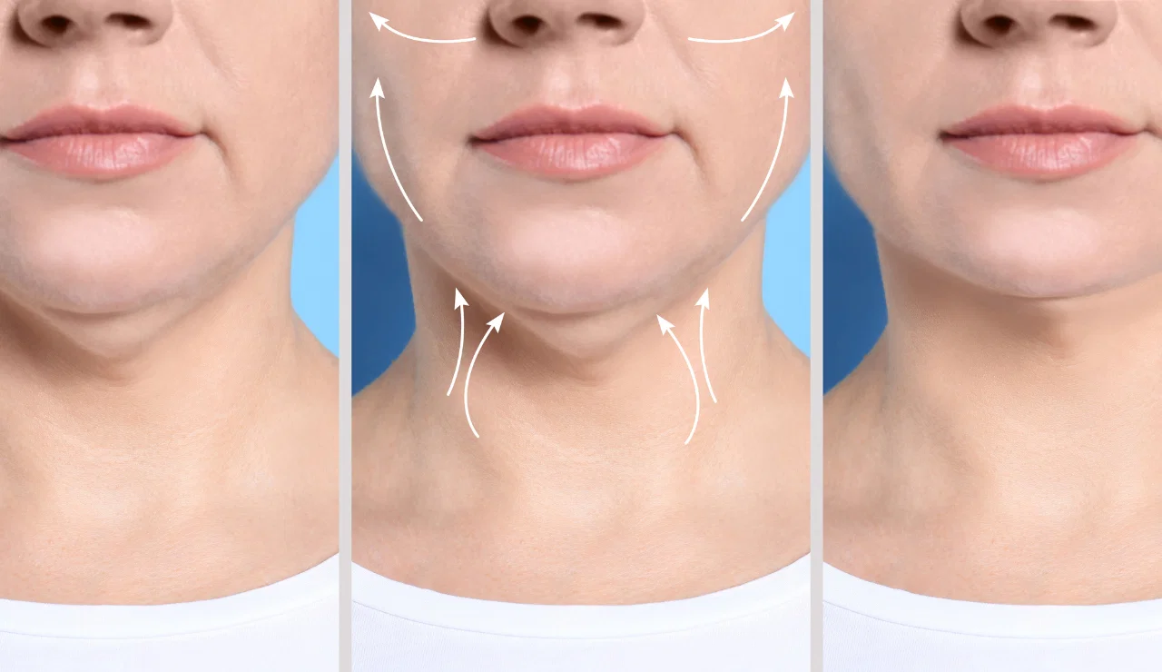 Double Chin Injection Testimonial-1