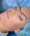 Eyelid Surgery