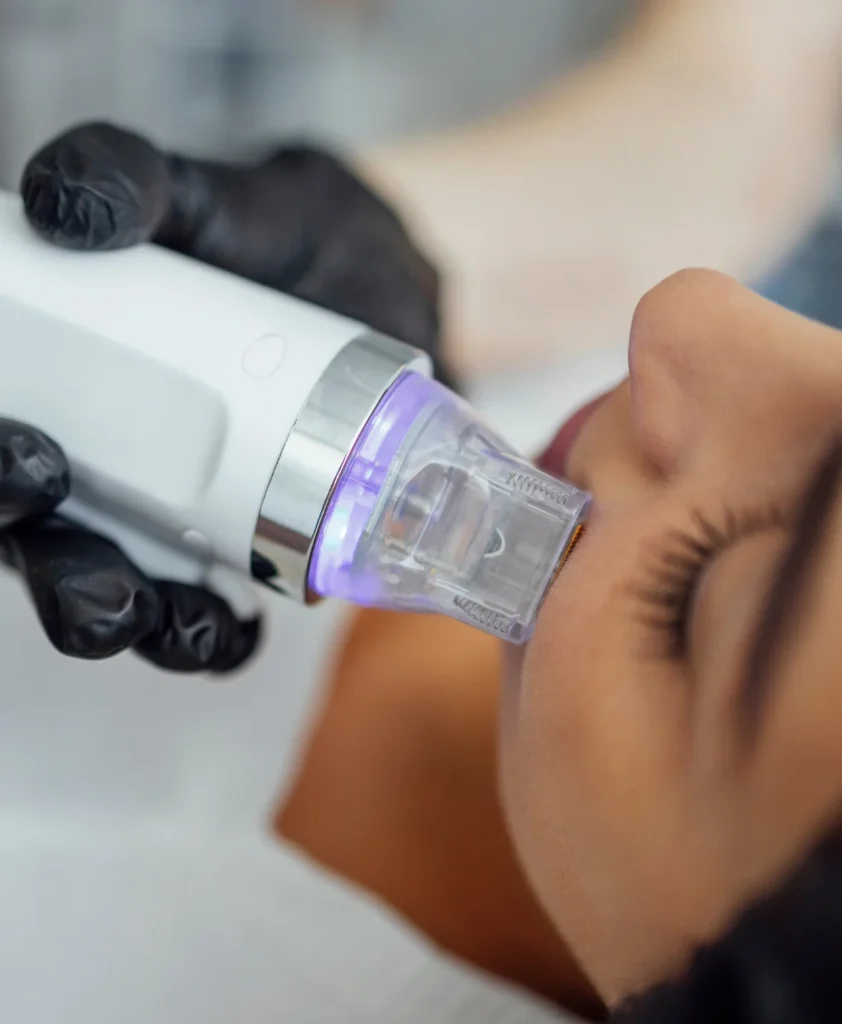 Image 4 Profound Microneedling