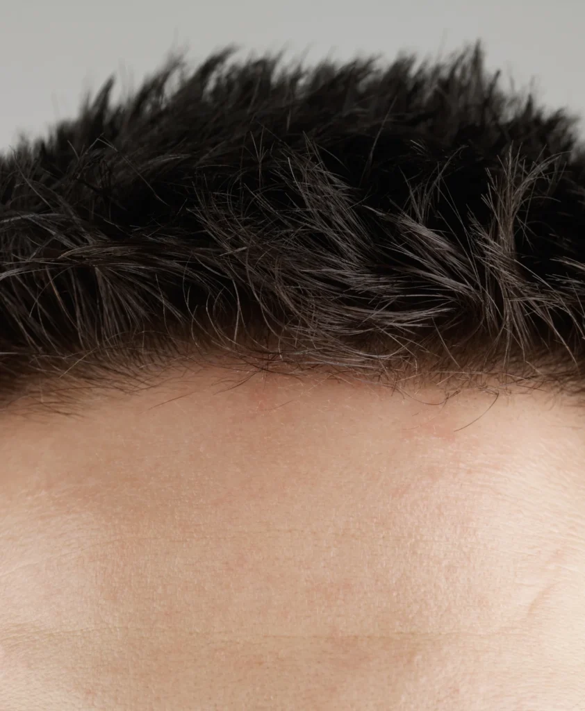 Forhead Lift