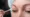Eyelid Surgery