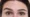 Forhead Lift