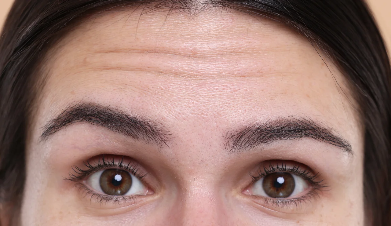 Forhead Lift