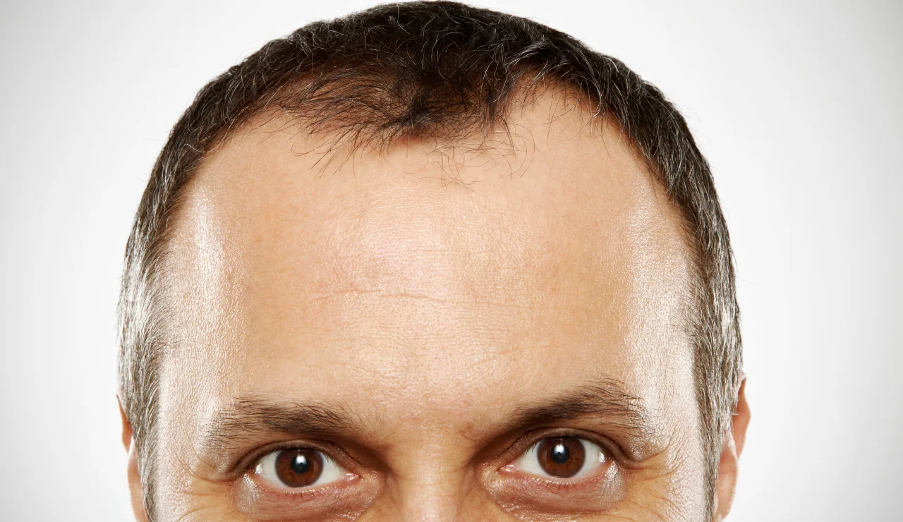 Forhead Lift