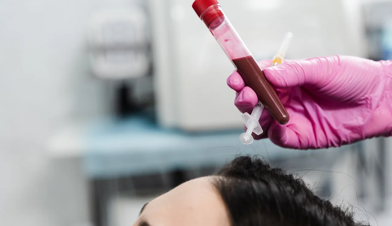 Platelet Rich Plasma