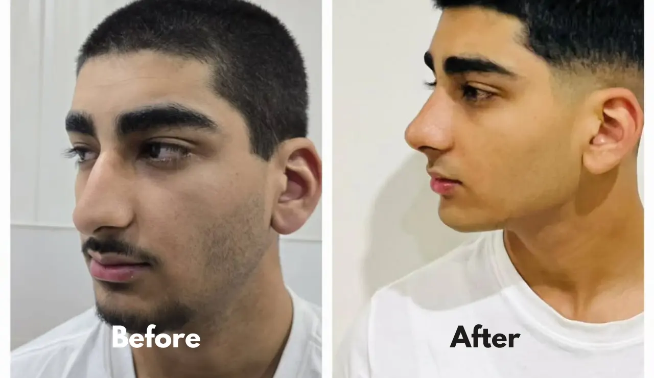 Rhinoplasty - testimonial