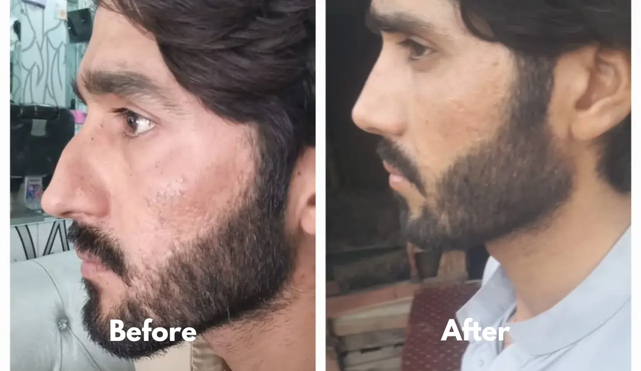 Rhinoplasty - testimonial