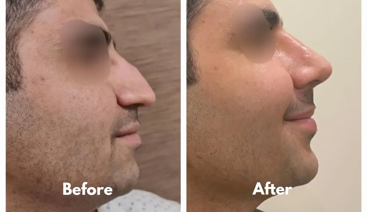Rhinoplasty - testimonial