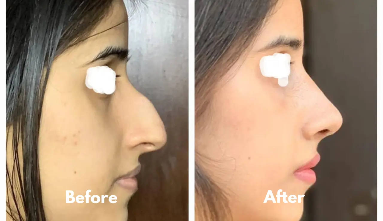 Rhinoplasty - testimonial