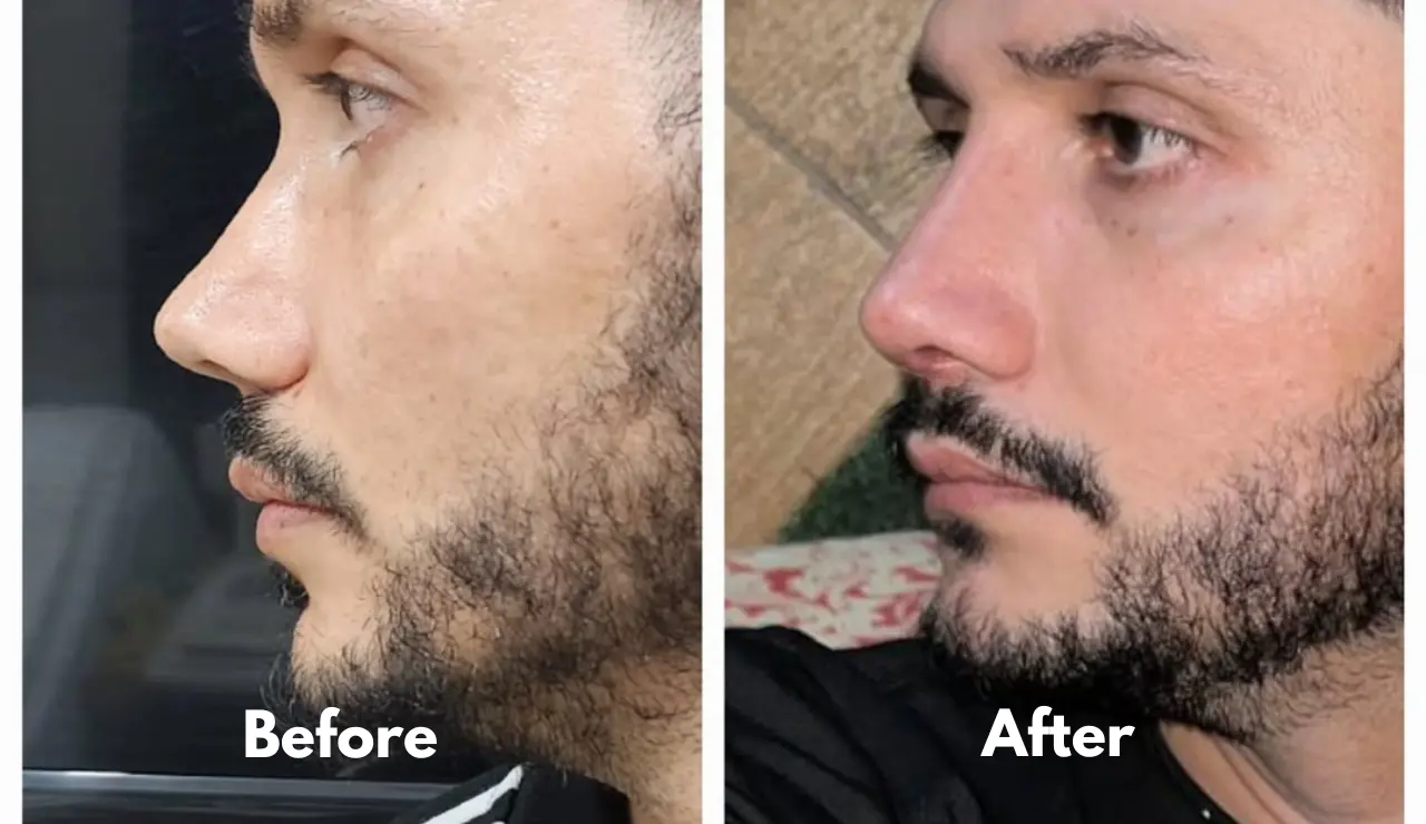 Rhinoplasty - testimonial