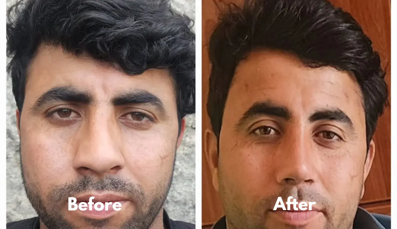Rhinoplasty - testimonial