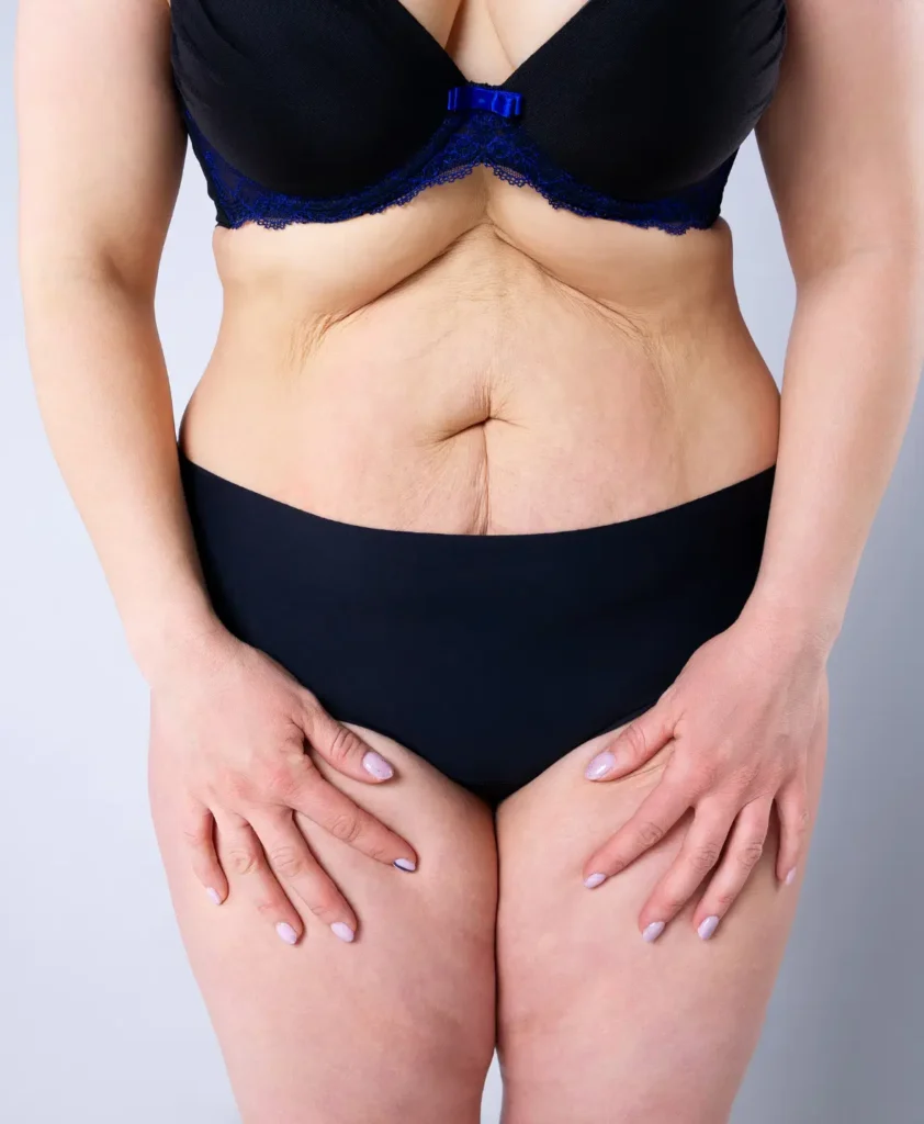 Tummy Tuck Risks