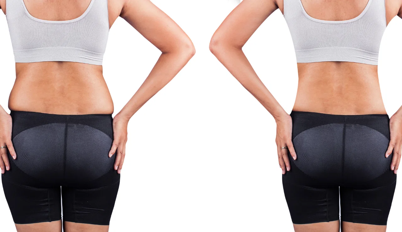 before and after fat transfer-2