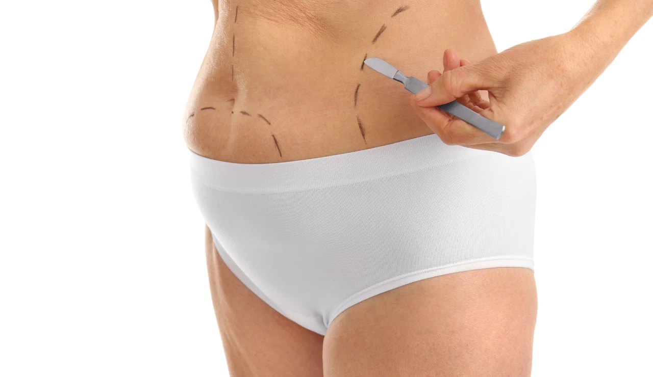 liposuction testimonial 2