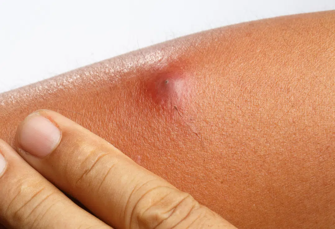 Abscesses & Cellulitis