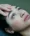 Blepharoplasty
