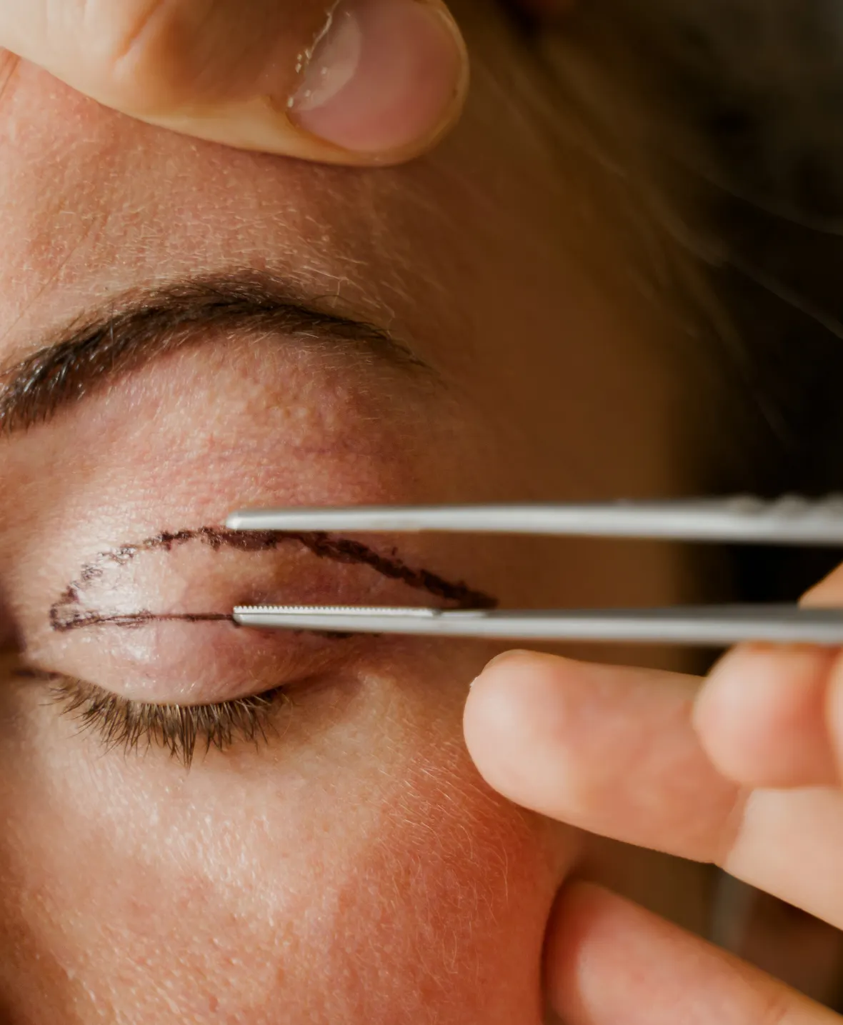 Blepharoplasty Procedure 1180x1435 img