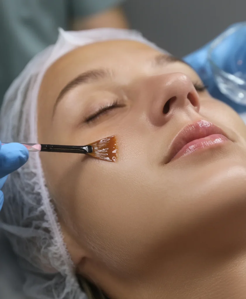 Chemical Peel Procedure