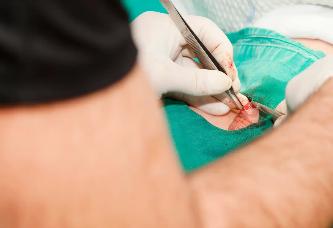 Circumcision - Thumbnail