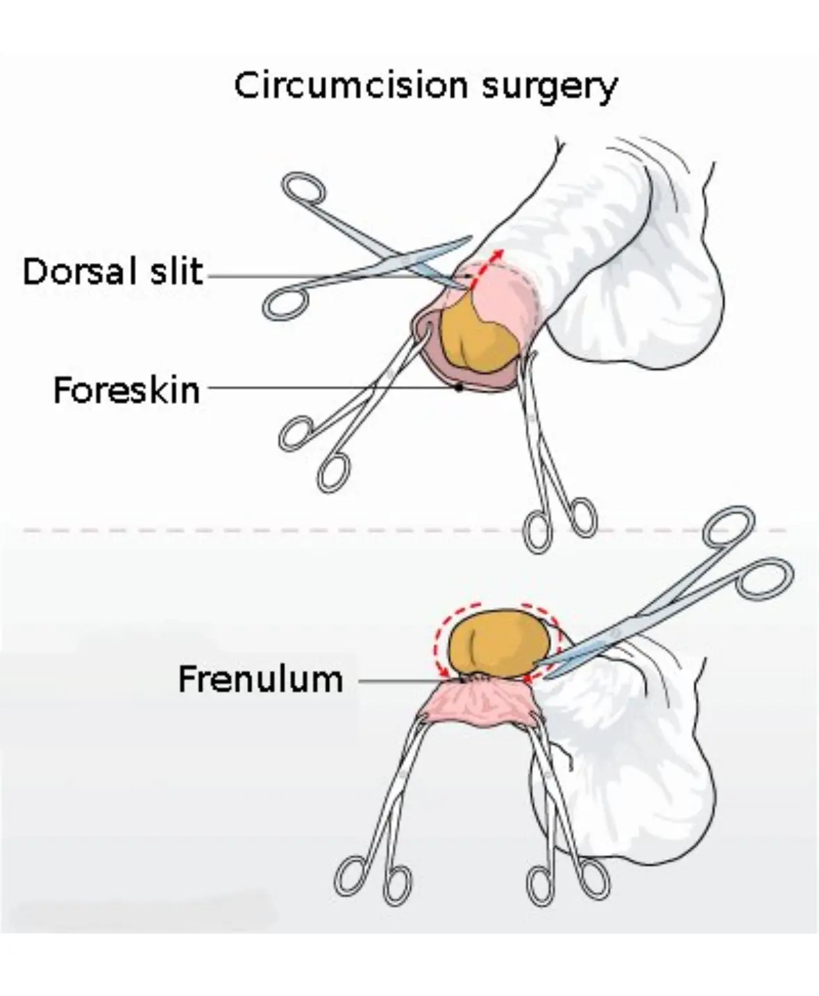 Circumcision