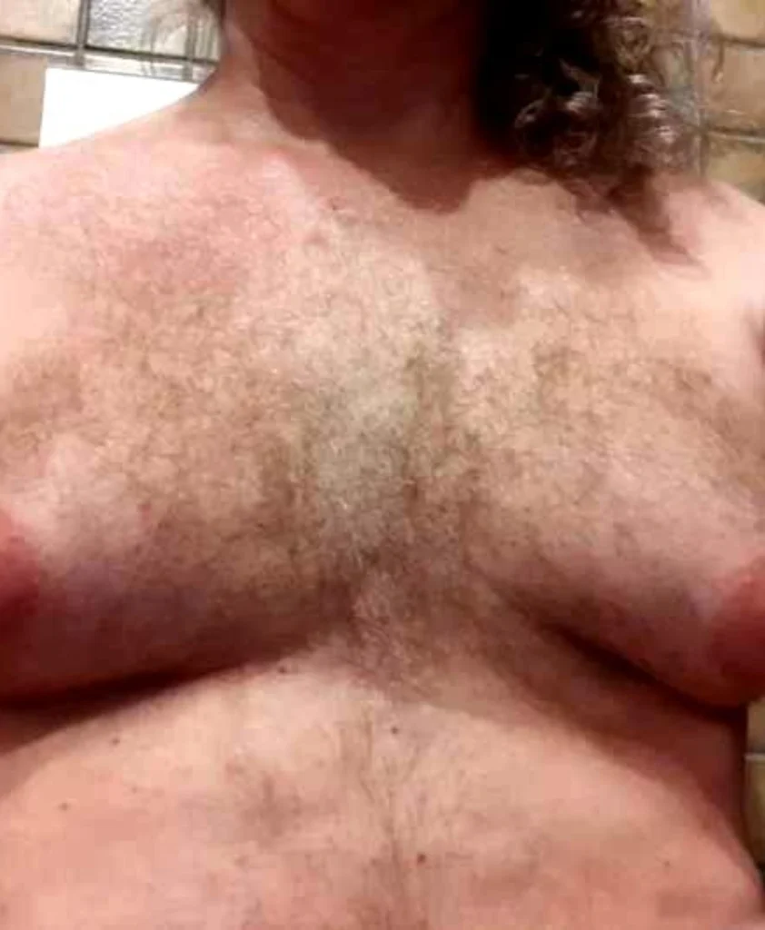 Gynecomastia