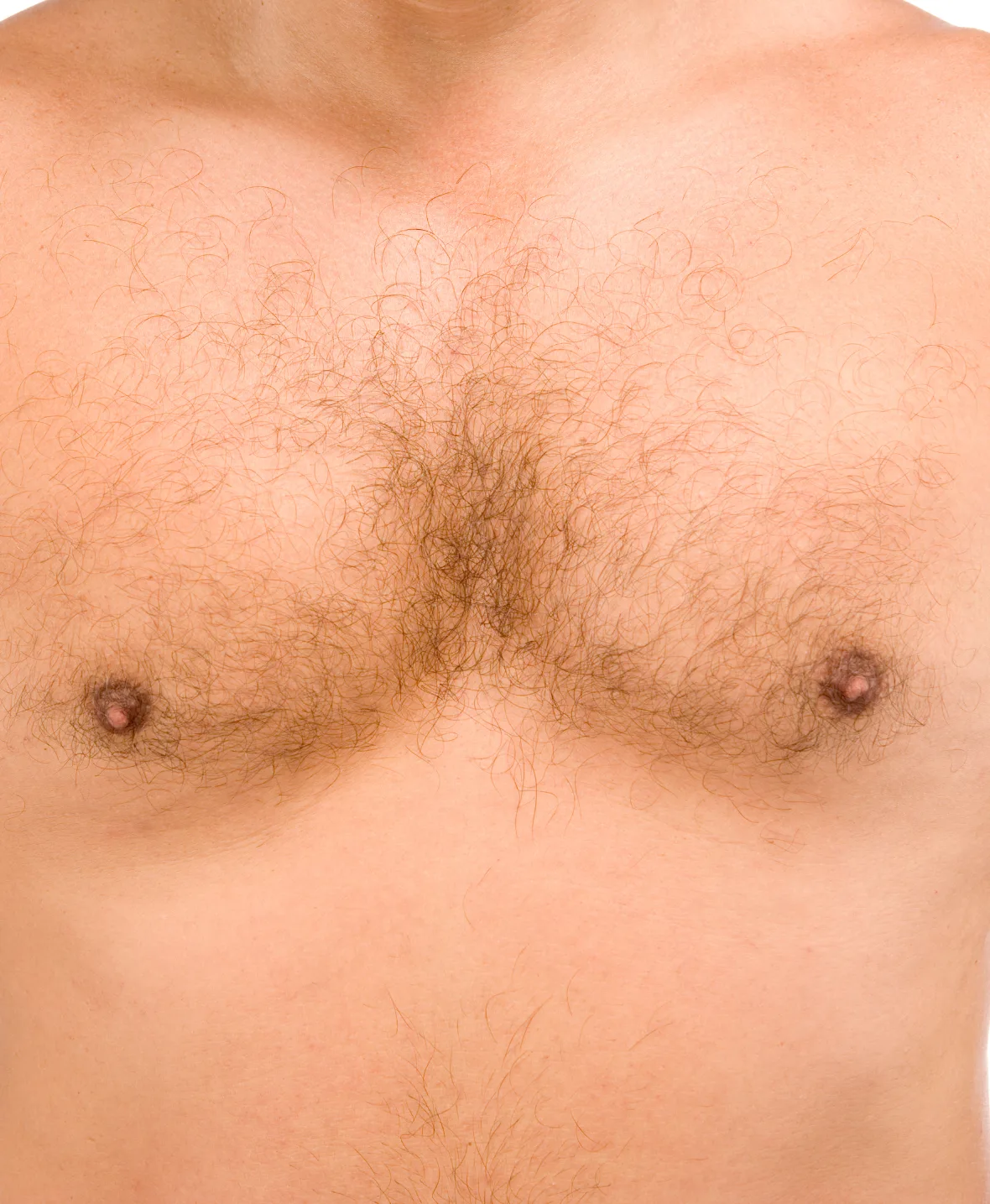 Gynecomastia