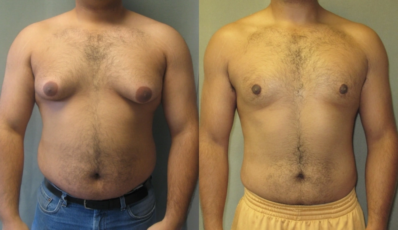 Gynecomastia - Testimonial