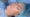 Gynecomastia - Blepharoplasty Testimonial