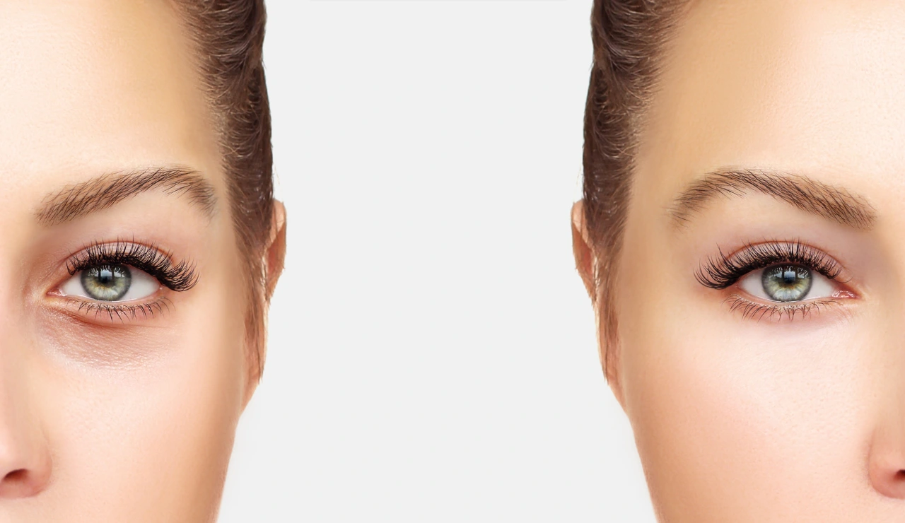 Gynecomastia - Blepharoplasty Testimonial