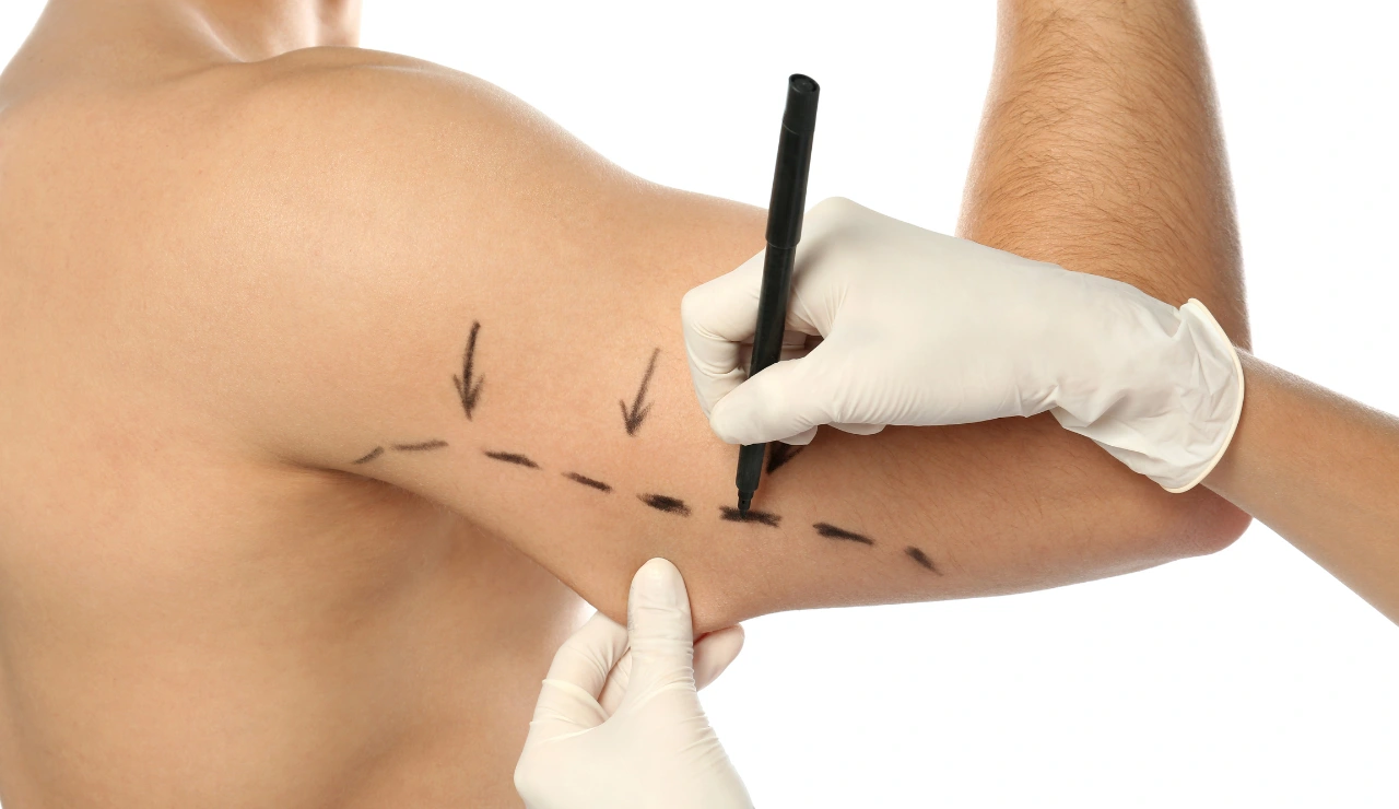 Gynecomastia - Brachioplasty Testimonial