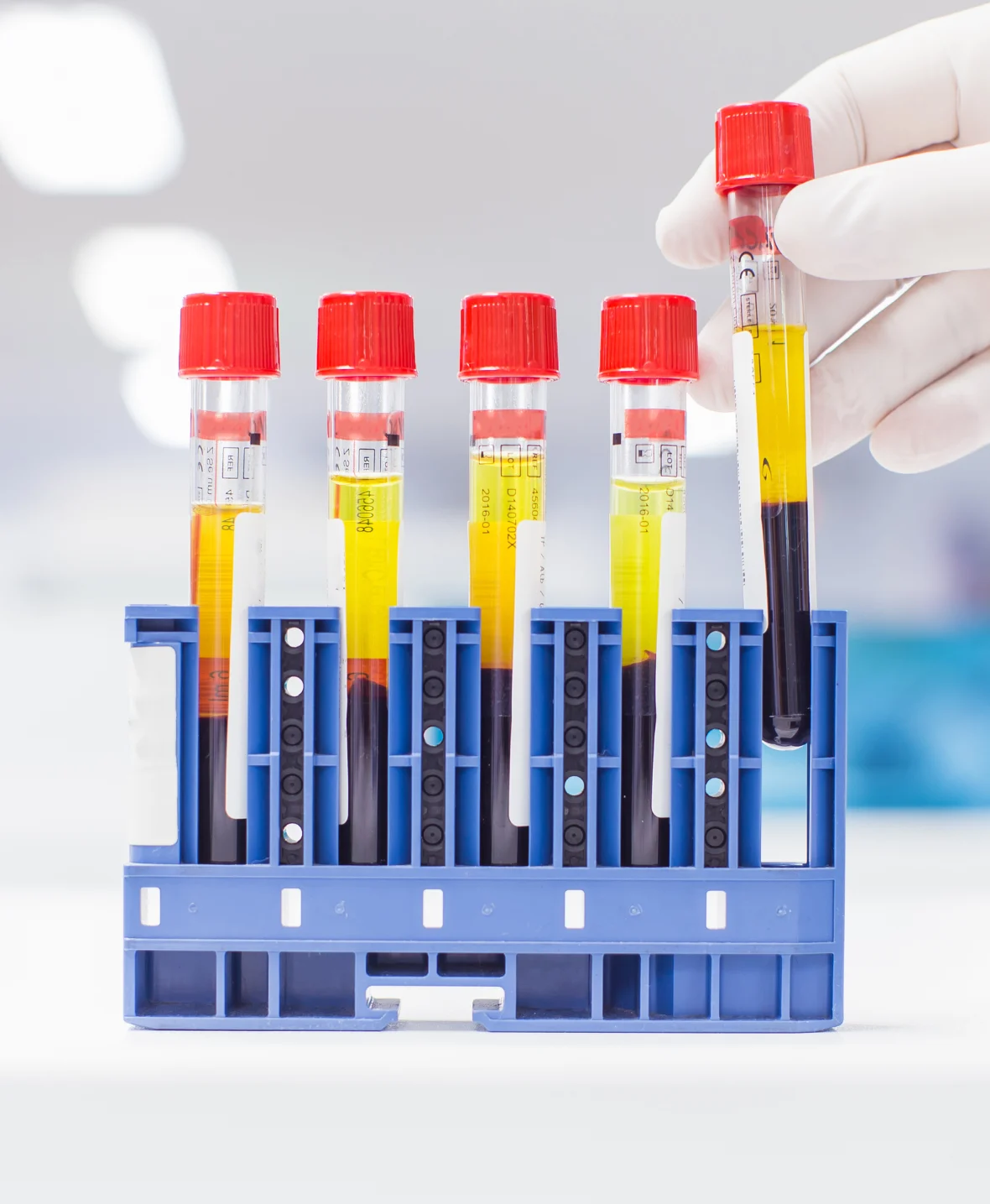Hematuria (Blood in Urine)
