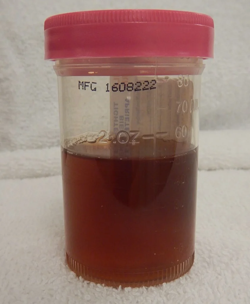 Hematuria (Blood in Urine)