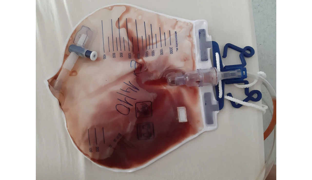 Hematuria (Blood in Urine)