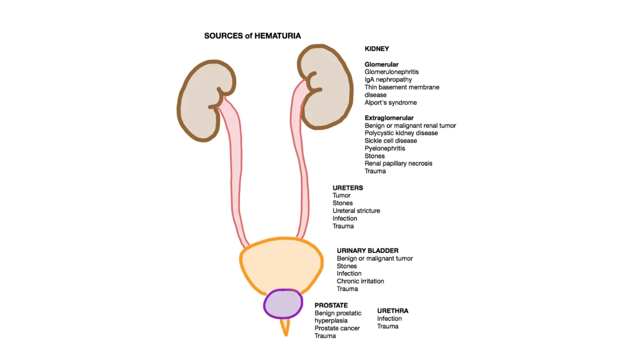 Hematuria (Blood in Urine)