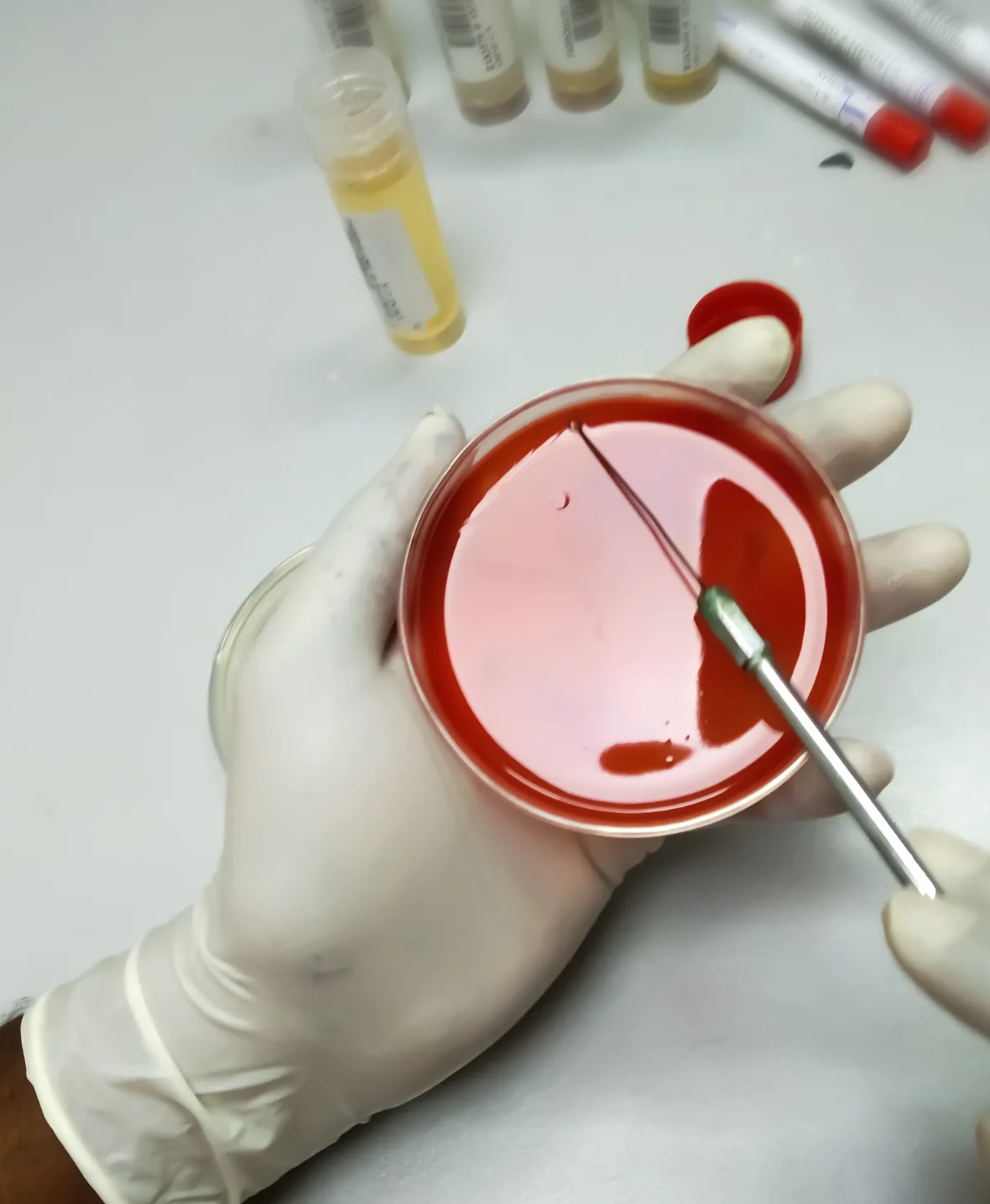 Hematuria treatment 1180x1435 img2 2