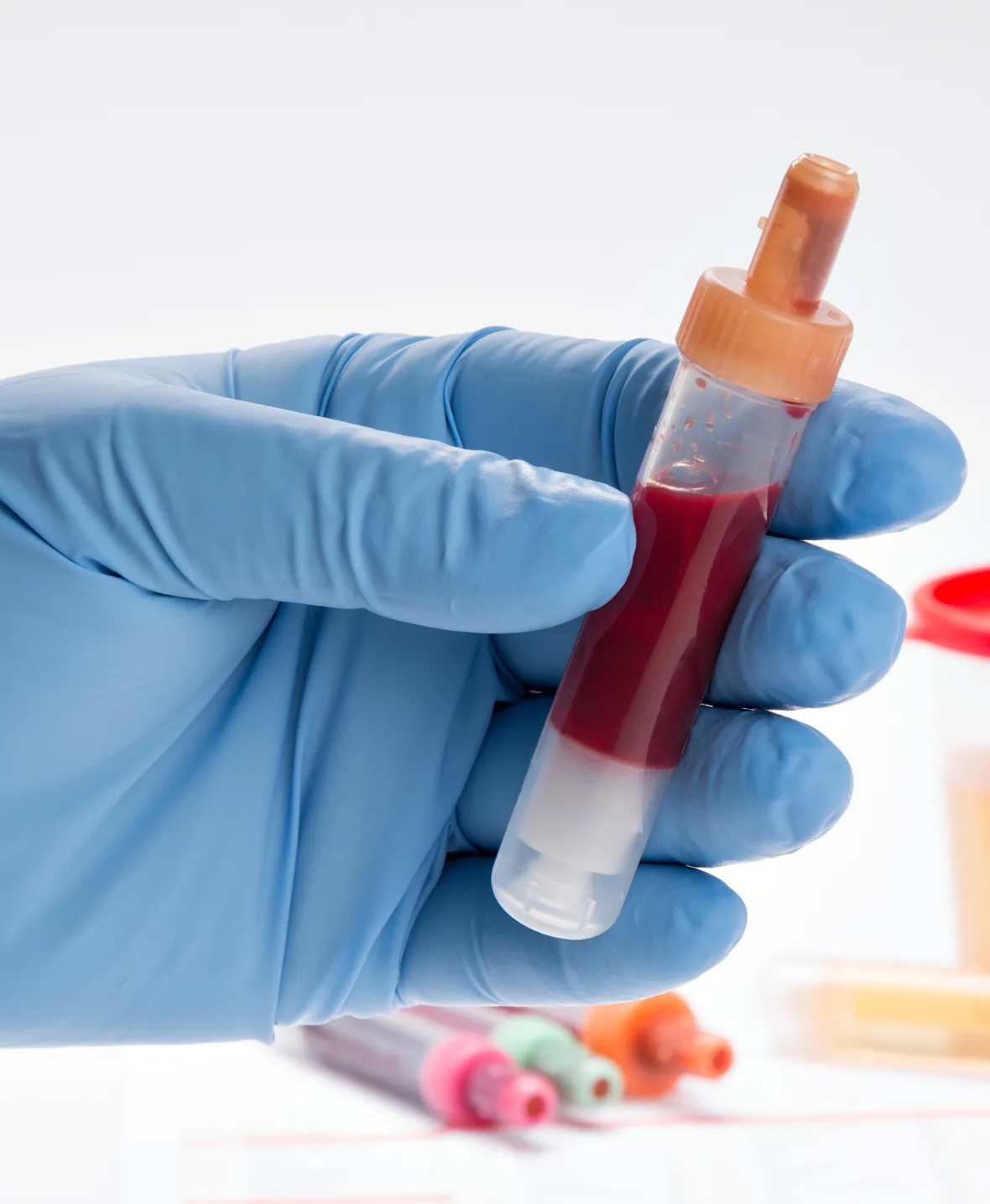 Hematuria treatment 1180x1435 img2