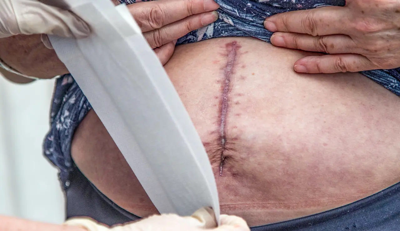 Hernia - Testimonial