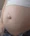 Hernia Procedure 1180x1435 img 2