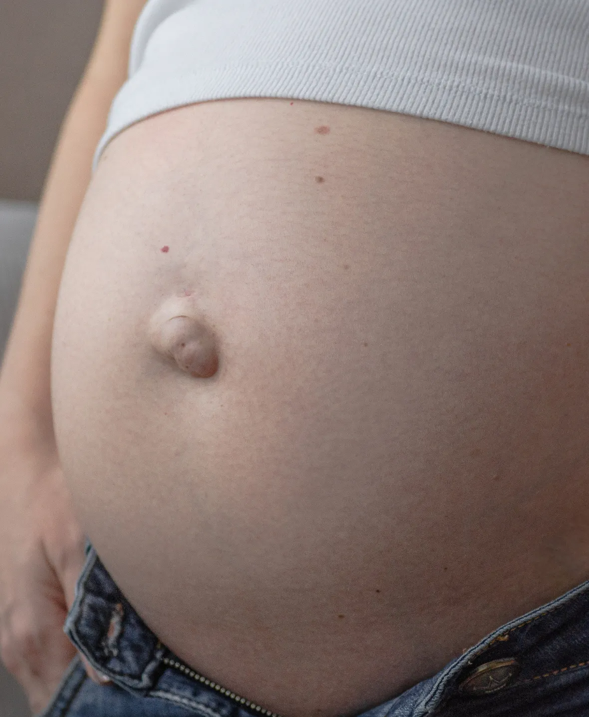 Hernia Procedure 1180x1435 img 2