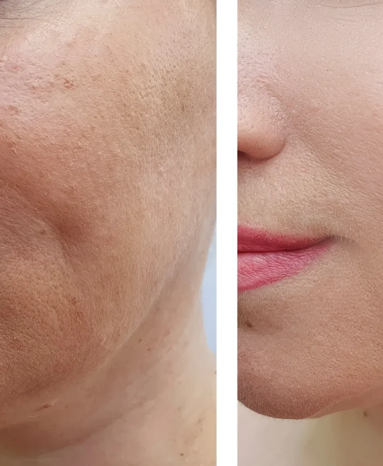 Jaw Slimming via Liposuction