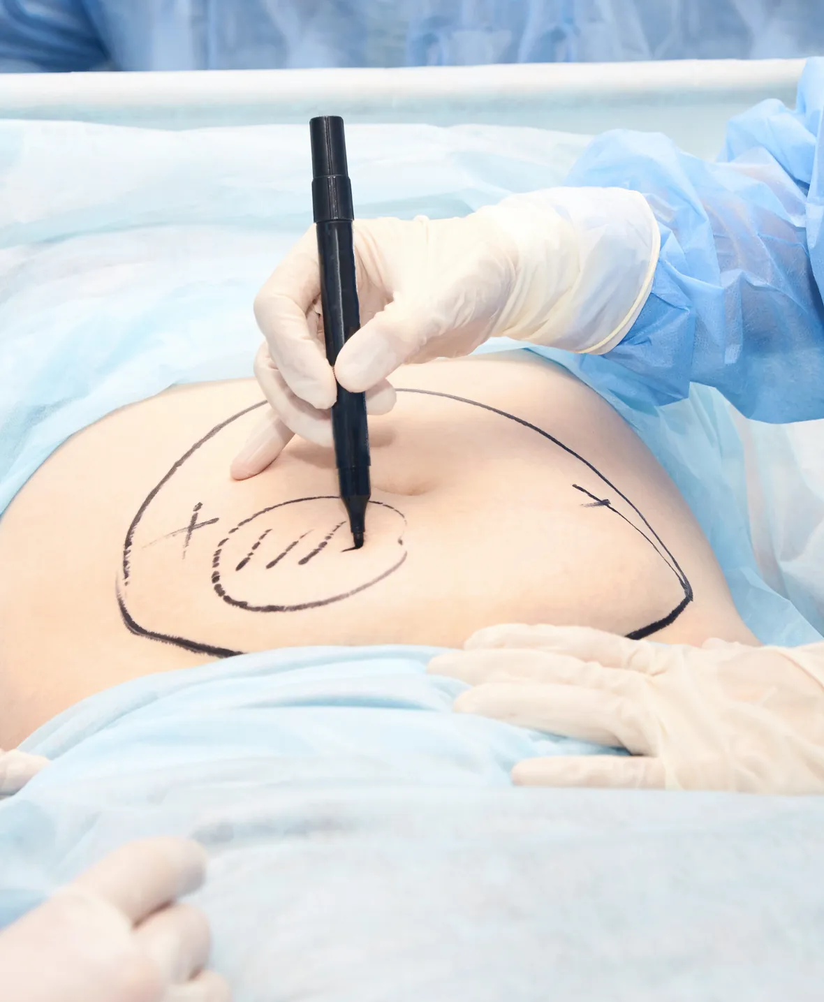 Liposuction 1180x1435 img2