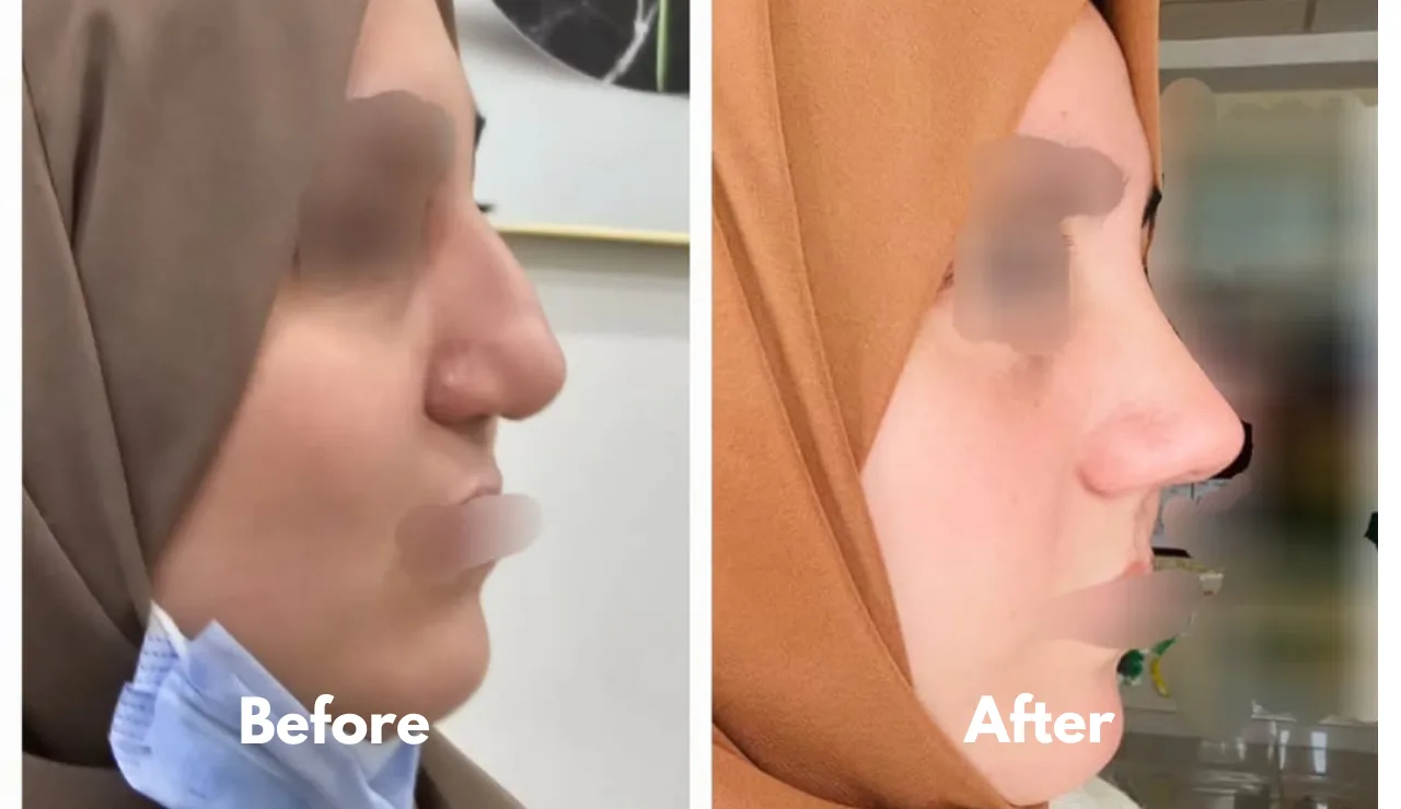 Rhinoplasty - testimonial