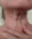 Skin Surgery