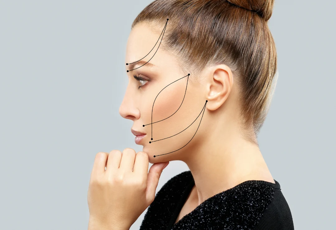 Thread Lift Procedure - Thumbnail