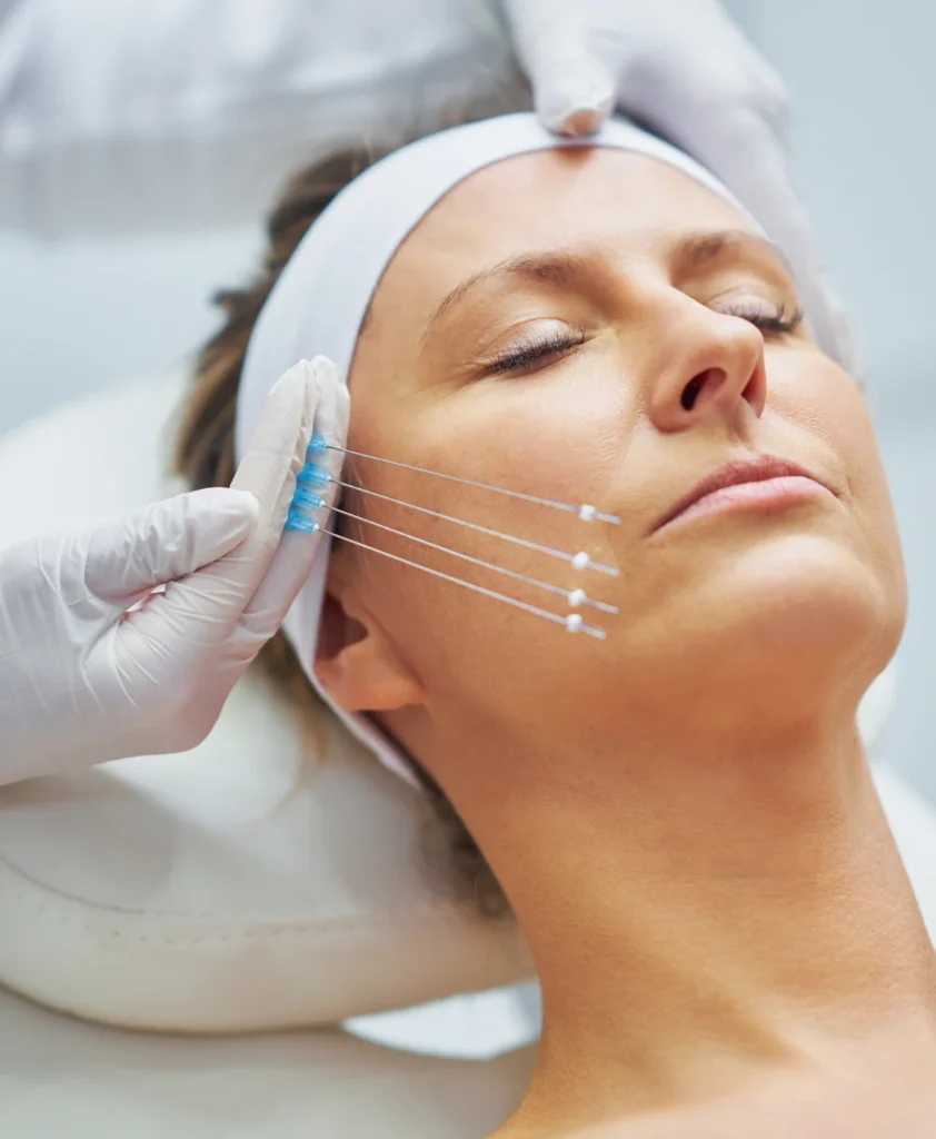 Thread Lift Procedure