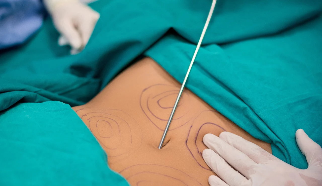 Vaser Liposuction - Testimonial