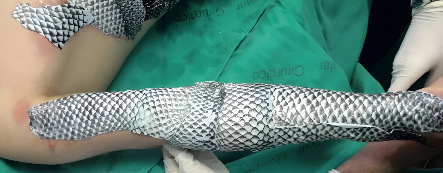 Acellular Fish Skin Grafts for Management of Split Thickness Donor Sites and Partial Thickness Burns A Case Series