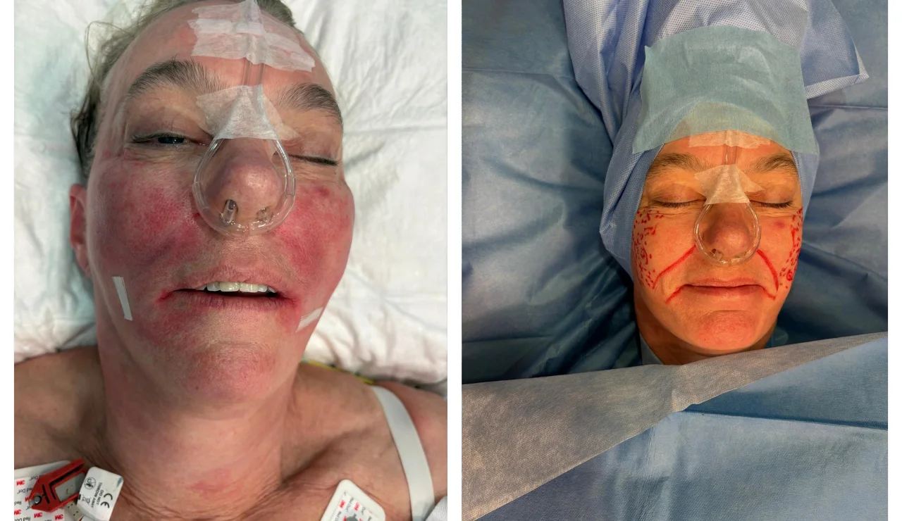 Face Fat Grafting img
