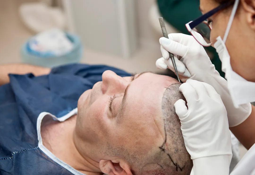 Hair Restoration & Transplantation - img